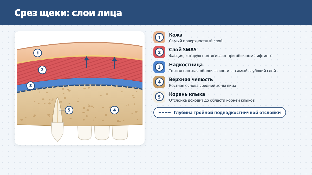 Срез щеки: кожа, слой SMAS, надкостница, верхняя челюсть и корень клыка